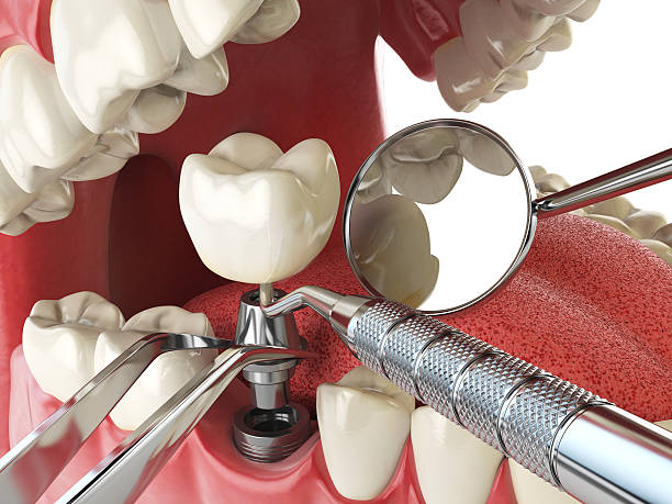 Best Knocked-Out Tooth (Avulsed Tooth) Treatment in Biltmore Forest, NC
